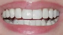 crown-after