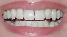 crown-before